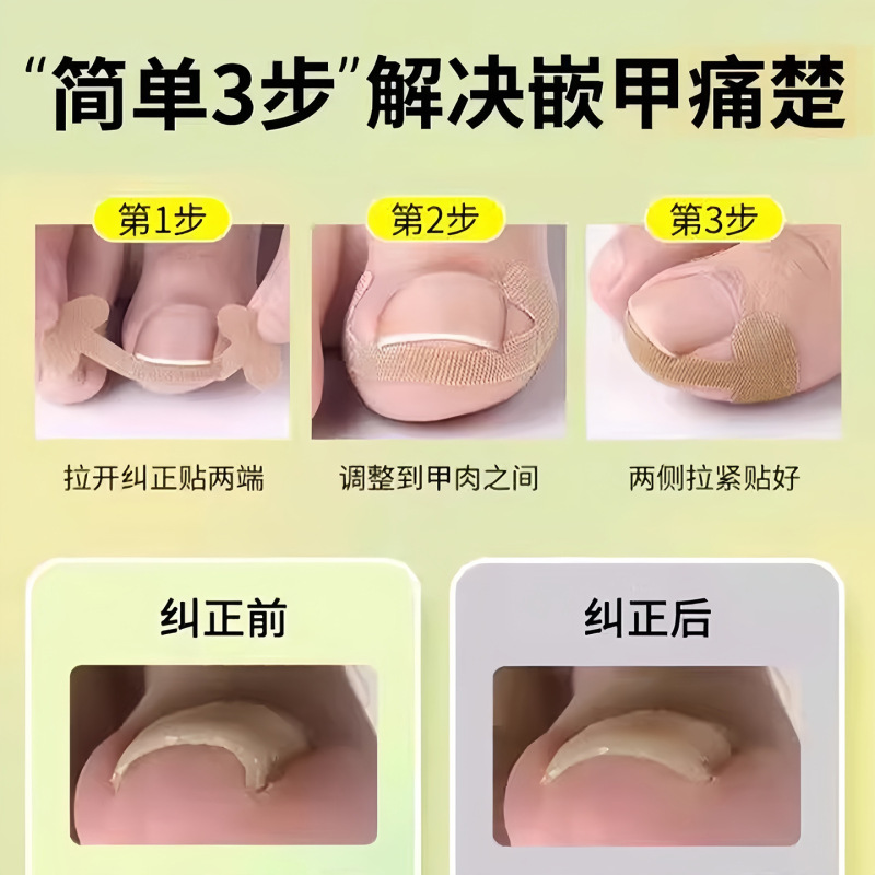 指甲矫正贴正甲贴指甲矫正器脚趾甲长肉里填充垫片纠正炎嵌甲拉贴|undefined