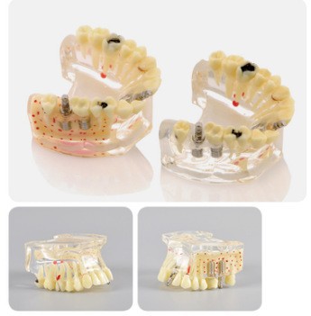 Modelo de ortodoncia dental semi-metal semibrackets Práctica de corrección de molde dental estándar Comunicación médico-paciente Modelo de enseñanza Modelo dental