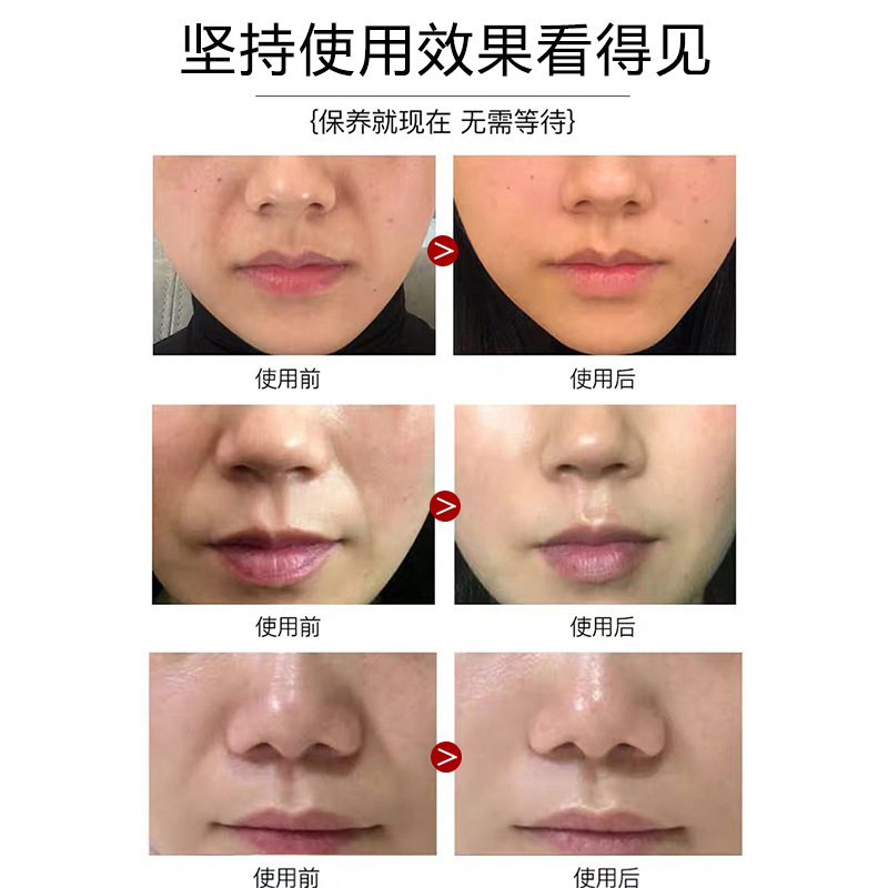 微結晶ほうれい線パッチ卸売リフティング、引き締め、小じわの軽減リフティングマスククロスボーダーハイドロゲルほうれい線パッチ|undefined