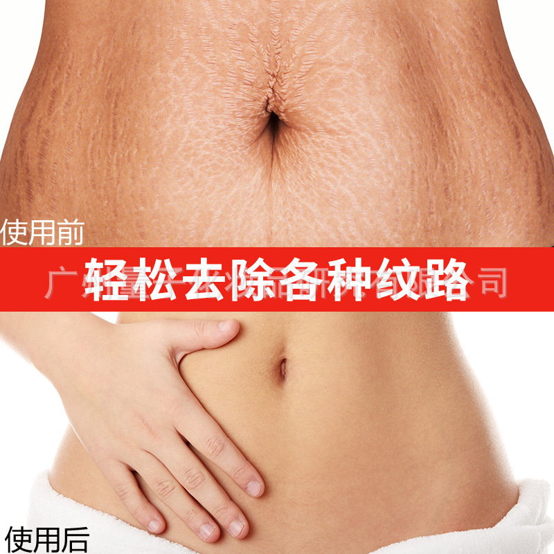 妊娠纹修复霜 肥胖纹妊娠纹产后修护霜膏紧致护理精油产后祛孕纹|ms