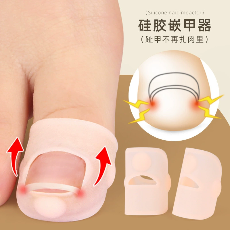 Устройство для ногтей с пазом для ногтей Устройство для вставки ногтей предотвращает рост депрессии ногтя в мясо