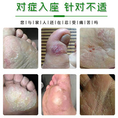 鄒潤安止癢快克止癢膏濕癢痛癢去菌去癬藥膏腳臭腳癢皮膚瘙癢批發