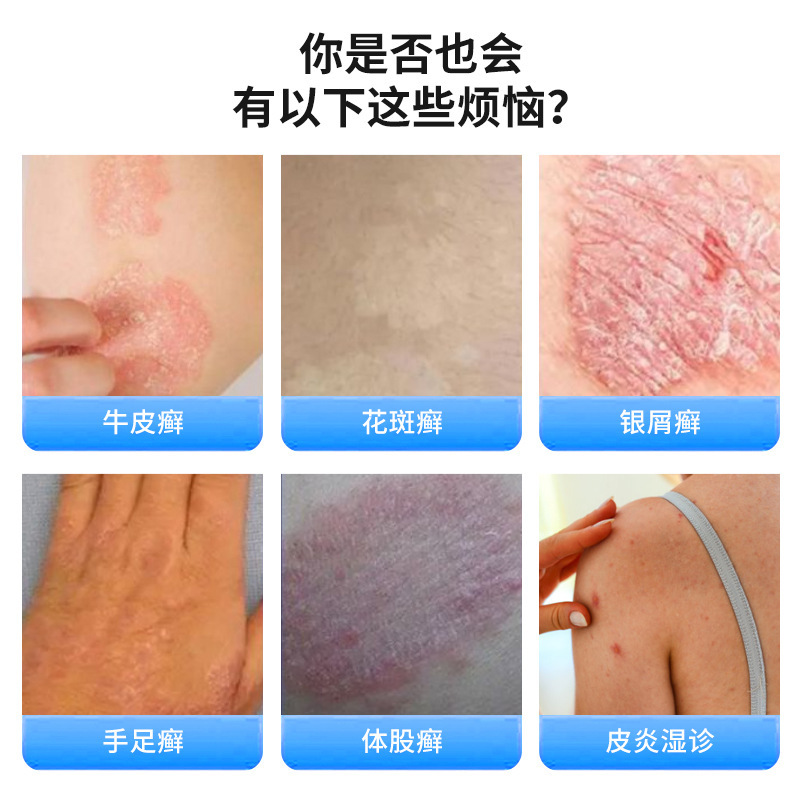 乾癬専用軟膏 乾癬を緩和するクリーム 肌の痒みや不快感を修復し、かゆみを和らげる乾癬専用軟膏|undefined