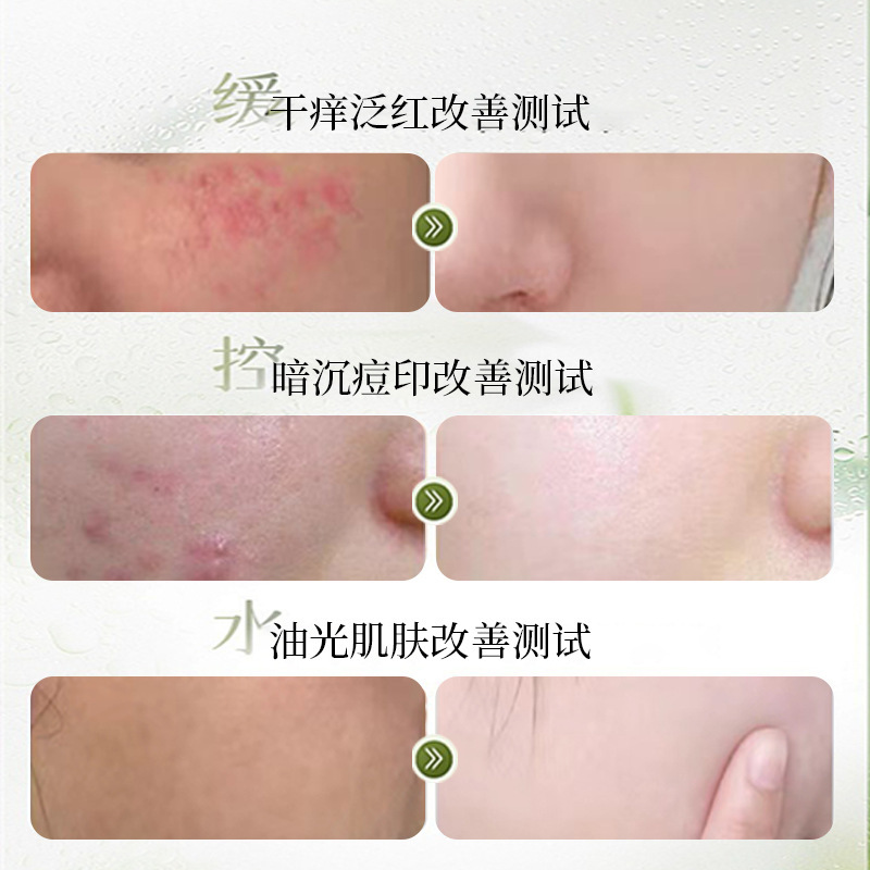 Dr. Xiangmei gel de aloe para el cuidado suave de acné acné 200g de gran capacidad de hidratante image 5
