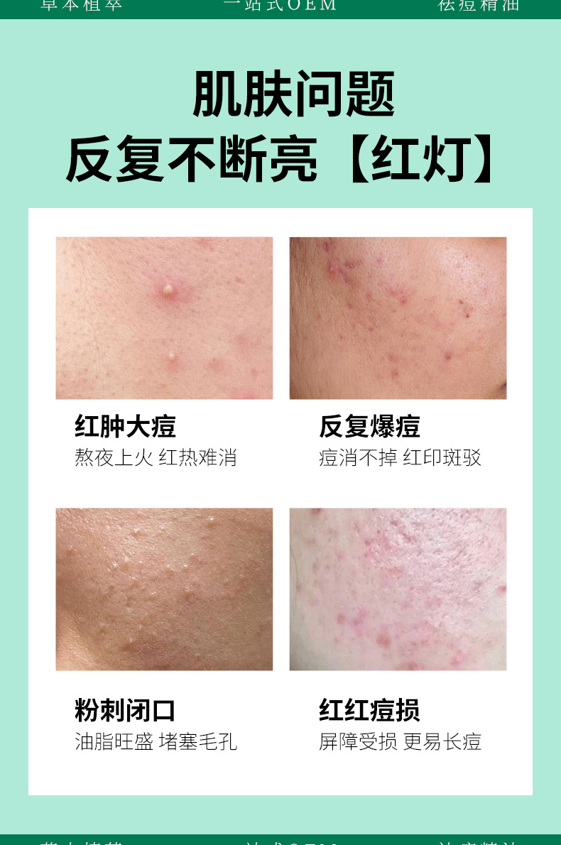 Acne Care Essential Oil Blend for Blemish-Prone Skin 15ml Topical Repair Oil specifications