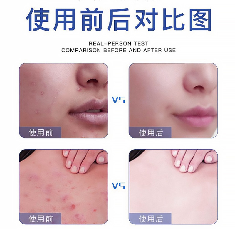 倾龄祛痘烟酰胺精华液全身清爽补水保湿喷雾男女通用现货代发正品|undefined