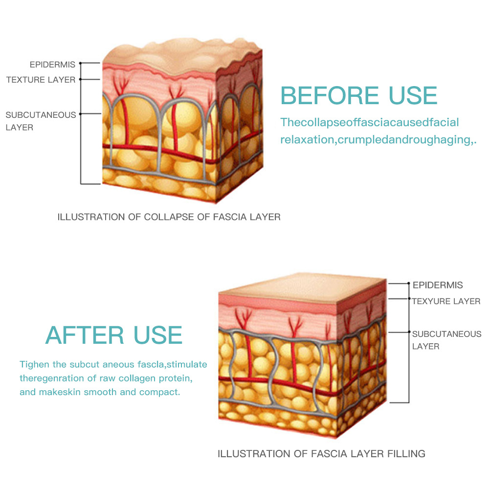 Facial Skin Tightening