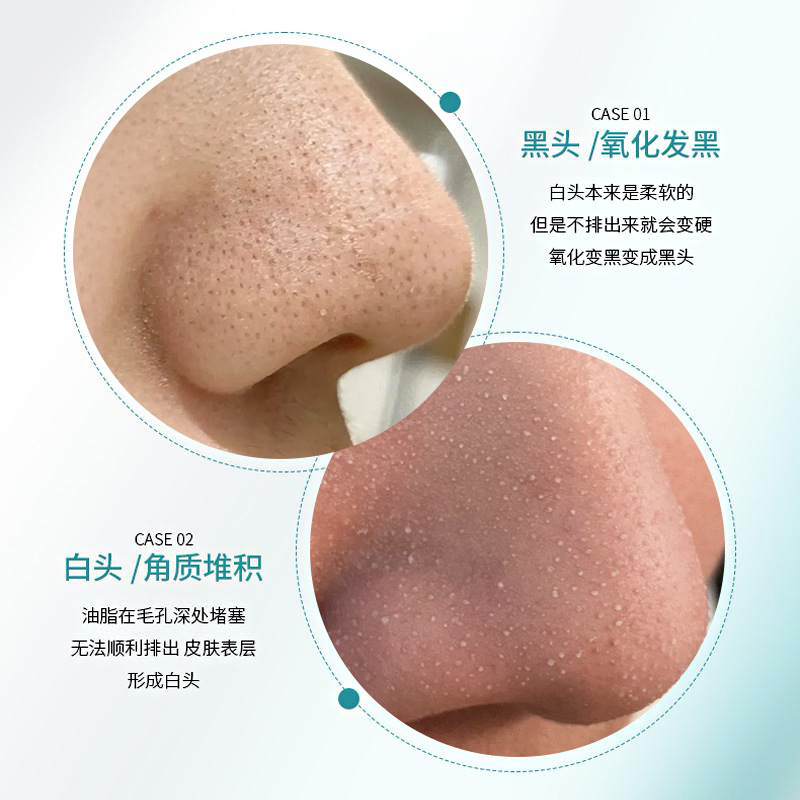 黑头导出液控油去黑头粉刺草莓鼻子白头粉刺闭口细腻毛孔黑头水|undefined