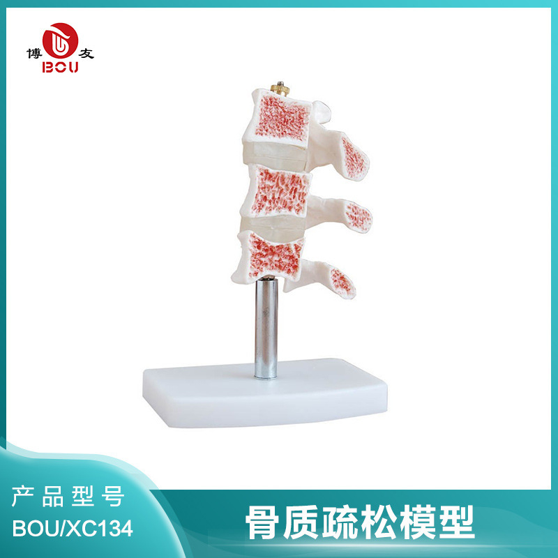 Boyou Osteoporosis Model Spinal Typical Lesion Model Spinal Model Bone Structure Osteoporosis