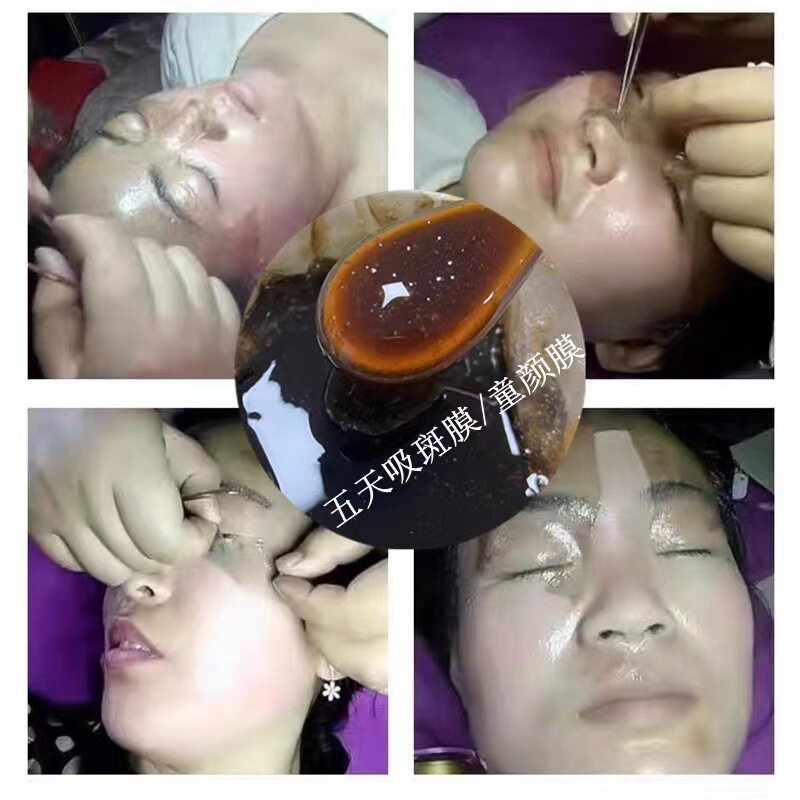 五天吸斑膜草本撕拉面膜祛簧媄白细腻毛孔亮肤去黑淡班美院专用|undefined