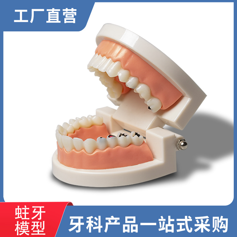 Modelo de caries dental para niños, modelo de cuidado de la enseñanza del cepillado de dientes de jardín de infantes, modelo de patología dental de la enseñanza oral
