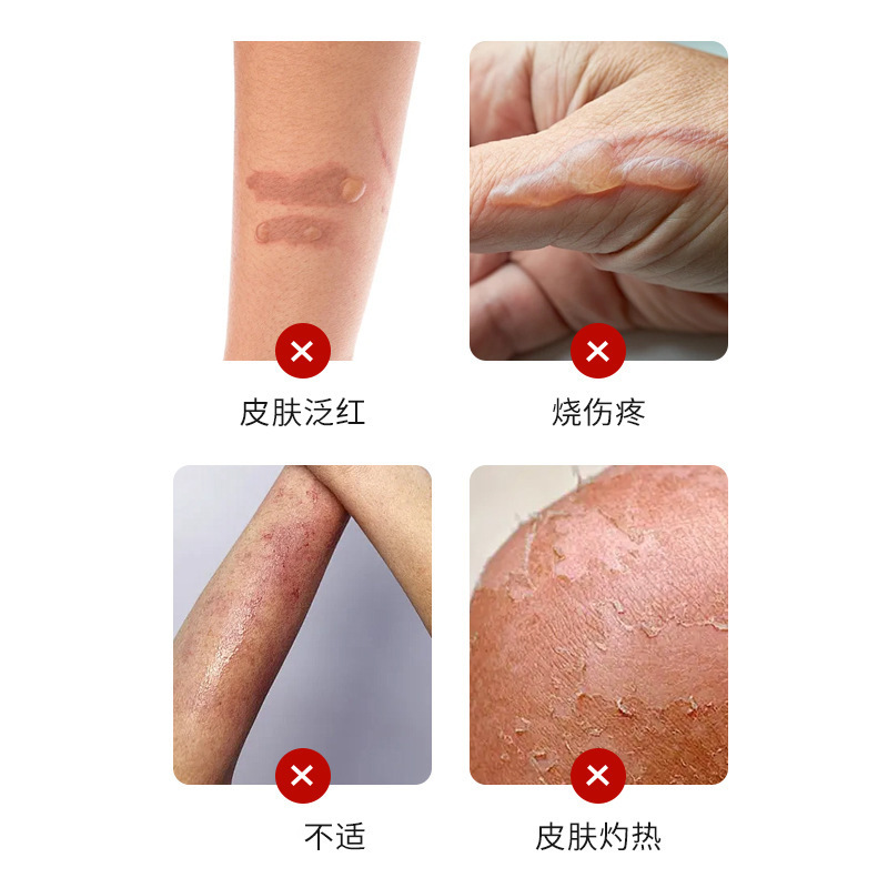 秋藤美川焼パーマ軟膏 皮膚の火傷、火傷、火傷、赤み、水ぶくれ、不快感、局所健康軟膏、卸売|undefined