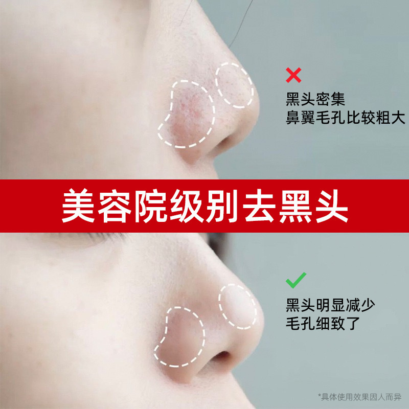 エステサロン専用の黒ずみ除去液でニキビを除去し、毛穴の奥まで洗浄し、小さな泡で毛穴を縮小します。|undefined