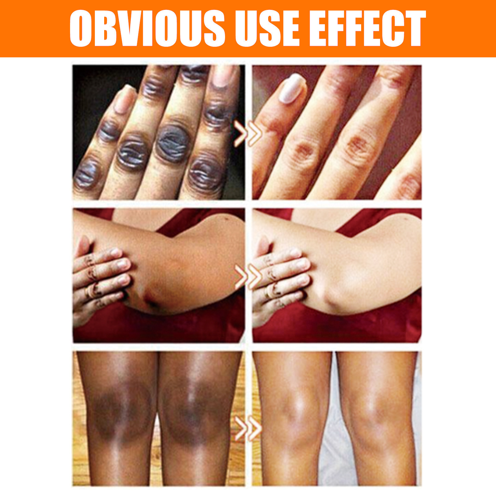 OUHOE Acanthus Whitening Achsel Ellenbogen Kniegelenk schwarz aufhellende Haut Schönheit Essenz_voghion.com