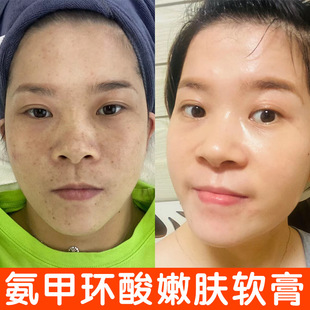 High Concentration Tranexamic Acid Cream to Remove Freckles, Whiten, Remove Chloasma, Age Spots, Freckles, Sun Spots, Melanin Color Control Cream