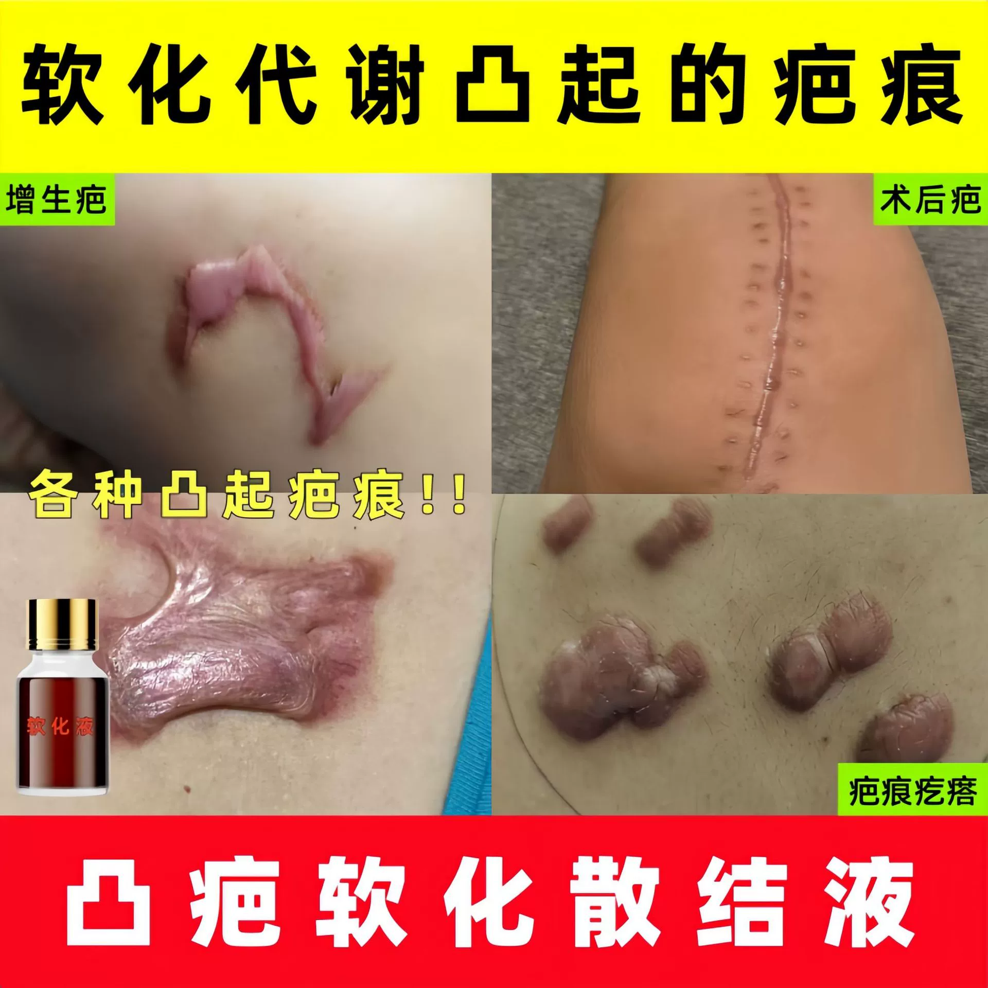 Выпуклый рубец Смягчение рубца, выпуклый рубец, гиперплазия, рубец, рубец, выпуклый рубец, раствор для рассеивания рубцов Jiaku, салон красоты