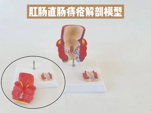 Human rectum hemorrhoids lesion model hemorrhoids internal and external anatomy anus anorectal colorectal pathology model