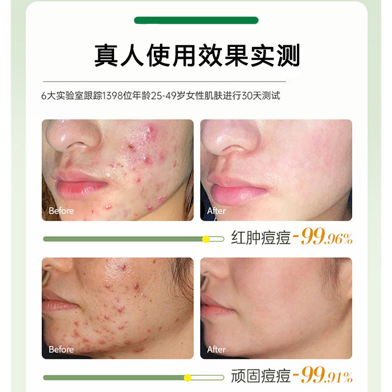 ニキビ跡を薄くするハーブニキビ治療エッセンス、ニキビ閉鎖ニキビ、毛穴縮小、美容室サリチル酸ニキビ治療水|undefined