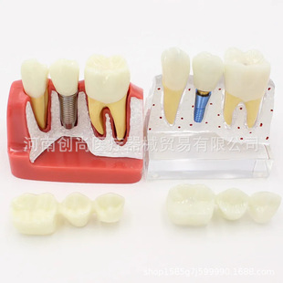 Dental 4-fold implant solution model Dental model Denture restoration Dental implant Removable bridge crown implant model