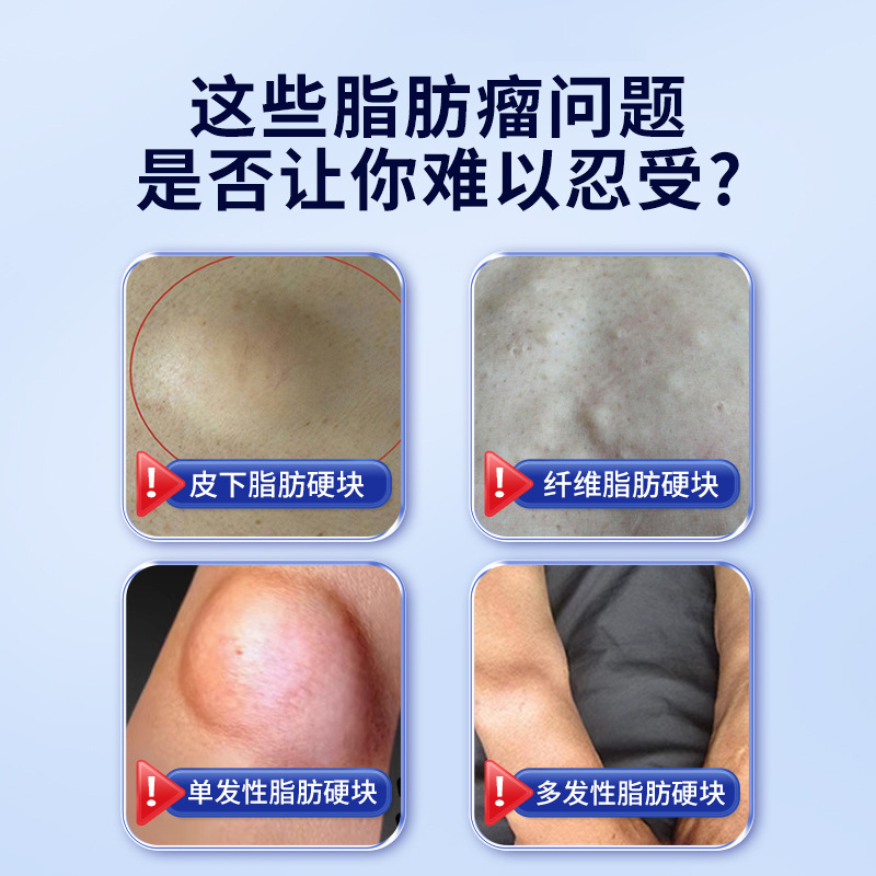 北京同仁堂脂肪康皮下消留去除膏针刀皮下除蓖麻子专用肿硬块去除|undefined
