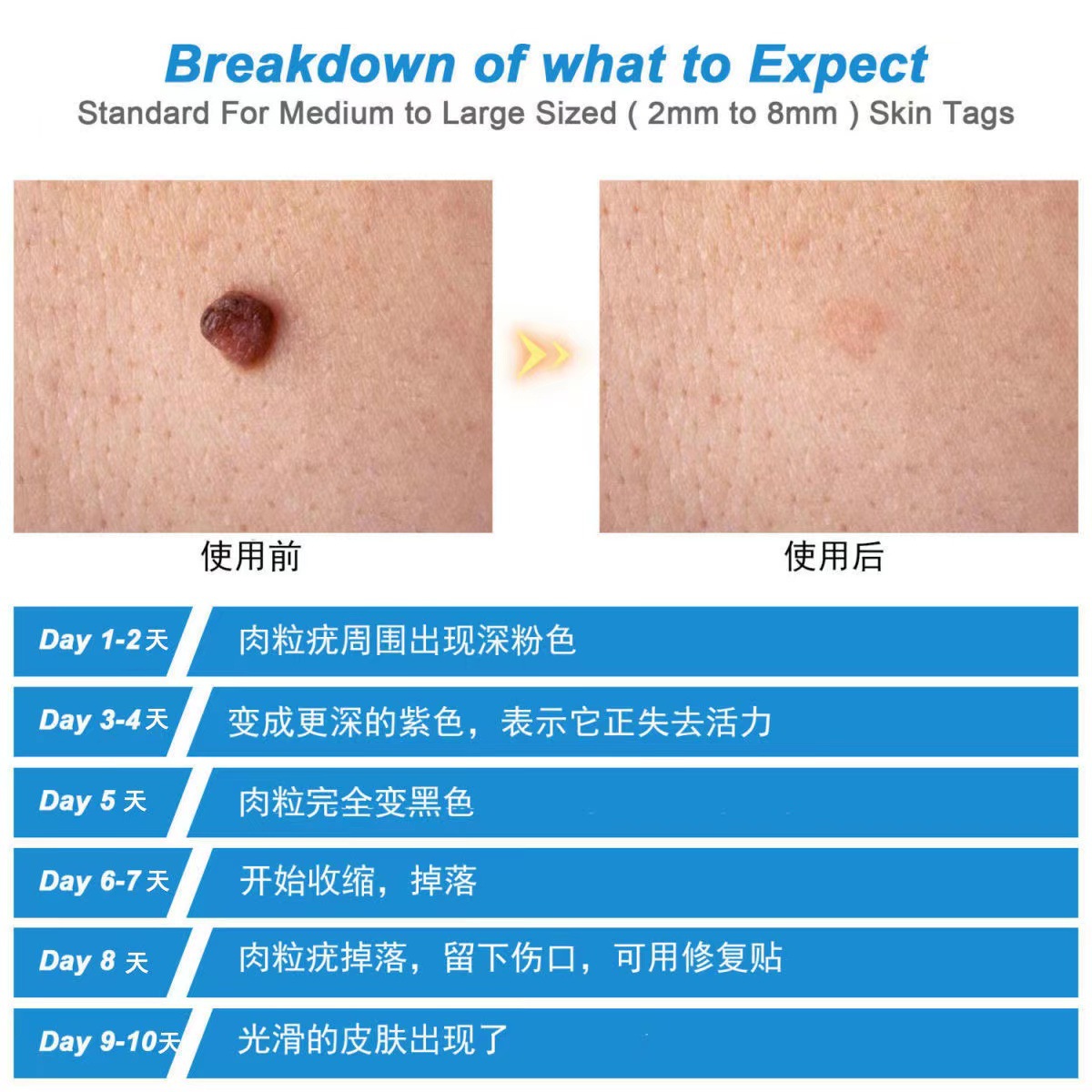 2-8mm pluma de eliminación de mole de carne callos eliminación removedor de verrugas 2-en-1 Herramienta Piel TagRemoval carne Espina grano de carne