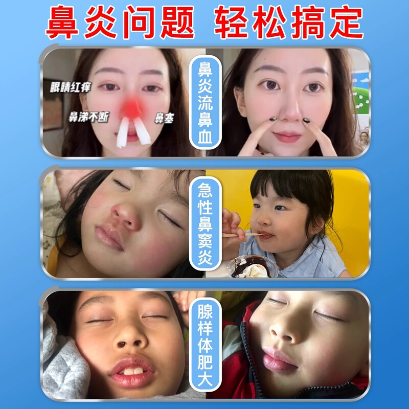 同普堂医用抗鼻腔过敏凝胶打喷嚏流鼻涕过敏性慢性鼻炎鼻塞鼻痒|undefined