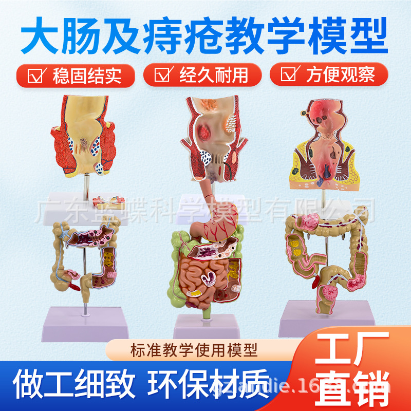 teaching simulation human body The large intestine Pathology Model stomach Rectum Hemorrhoids Pathological changes anatomy Intestine disease Colon Pathological changes