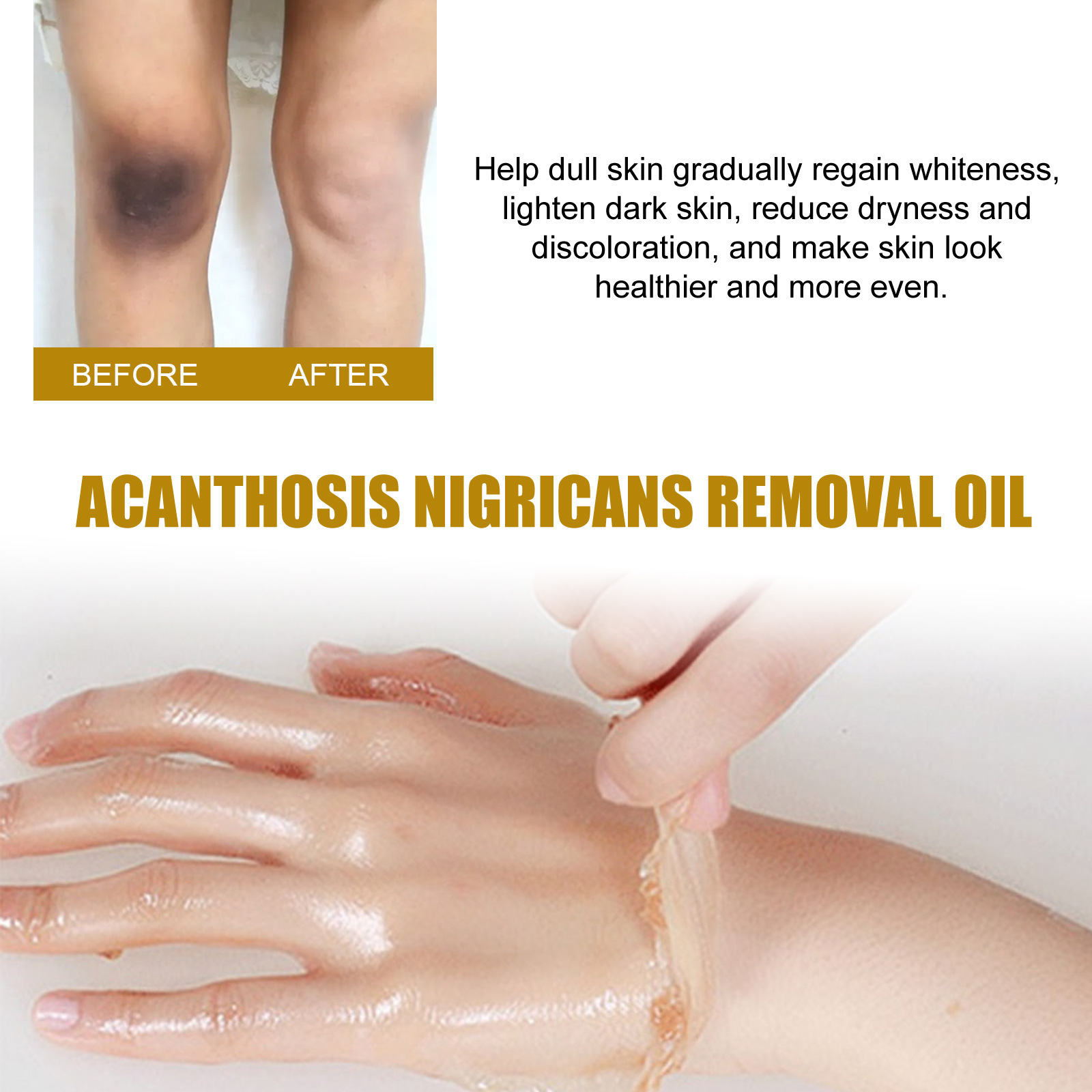 Huile éclaircissante pour traitement de l'acanthosis nigricans_voghion.com