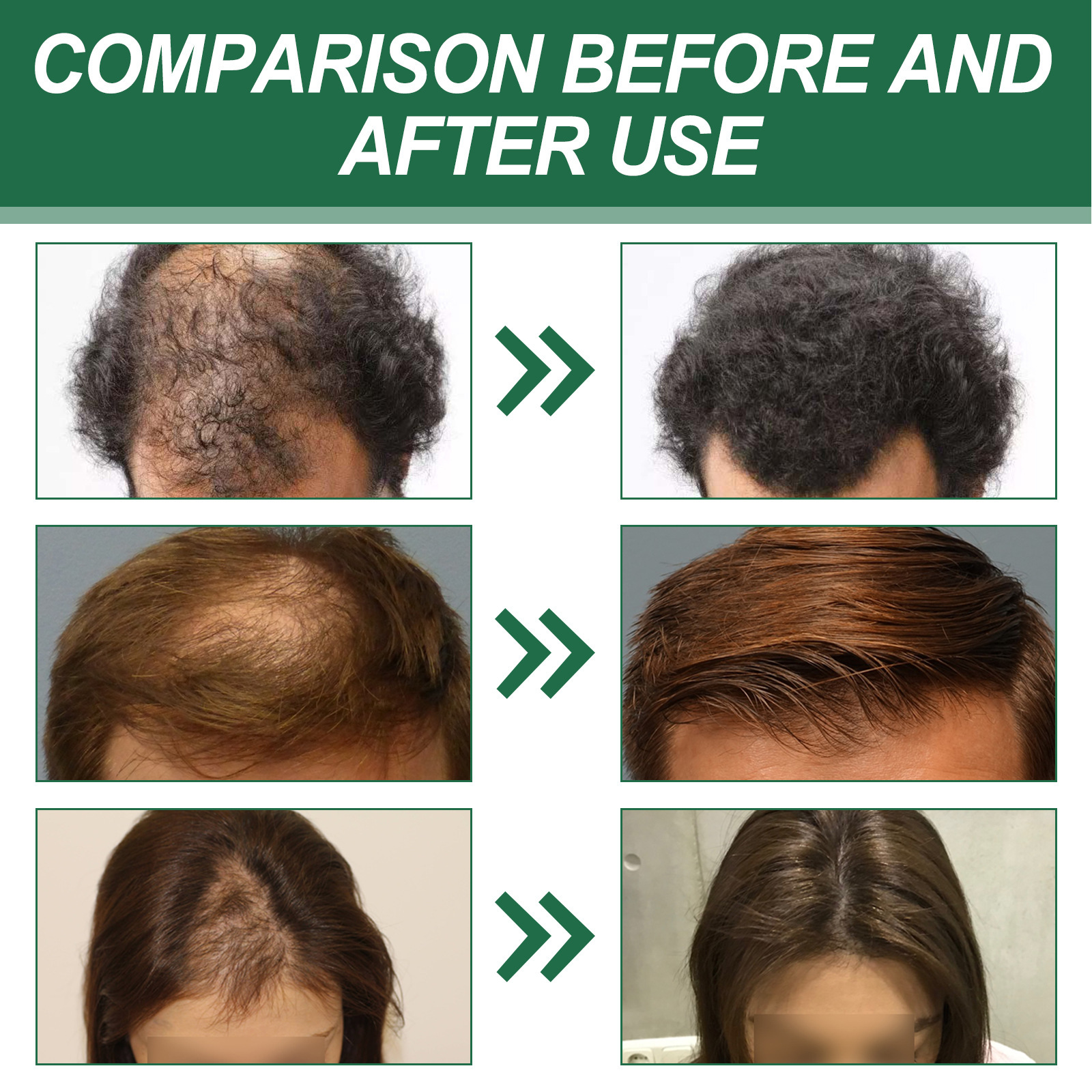 Cheveux denses East Moon pour prévenir la perte, hydratation ferme, cheveux forts et épais, massage du cuir chevelu, spray de soin capillaire_voghion.com