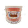 Dental front teeth, rear tooth openings front tooth orthodontic bangs posterior tooth open mouth bite pad mouth