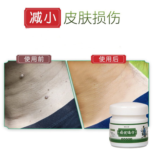厂家批发澳德力康疣瘊平 肤瓶膏体肉刺鸡眼减少瘊子膏 盒装