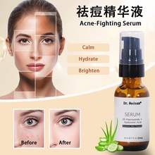 5%烟酰胺祛痘水菲律宾爆款抗痘修复精华液美白提亮跨境Anti-acne