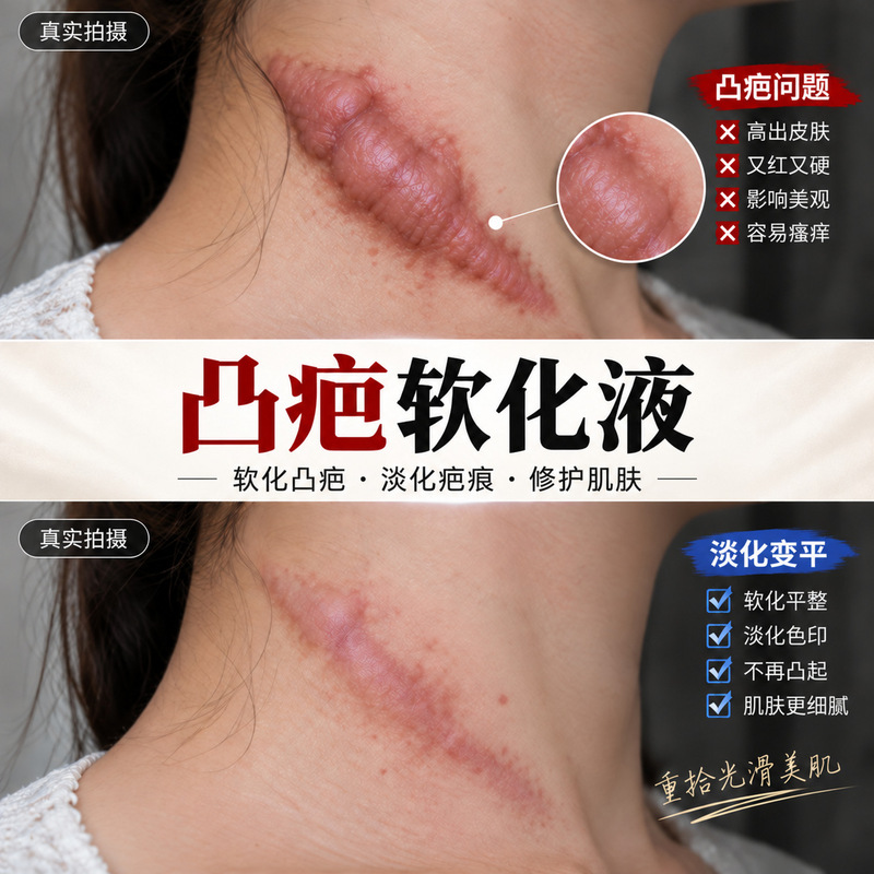 Convex scar softening solution, for repairing raised scars, softening keratin, and post-operative scar treatment; also suitable for burns and laser treatments