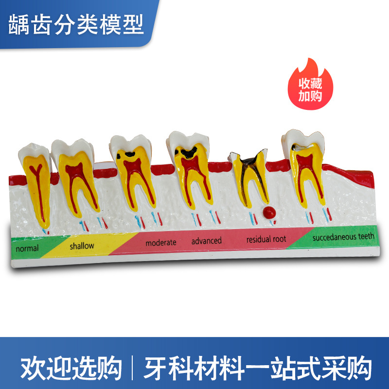 Modelo dental, modelo de enseñanza oral para la clasificación de caries, modelo didáctico, modelo dental