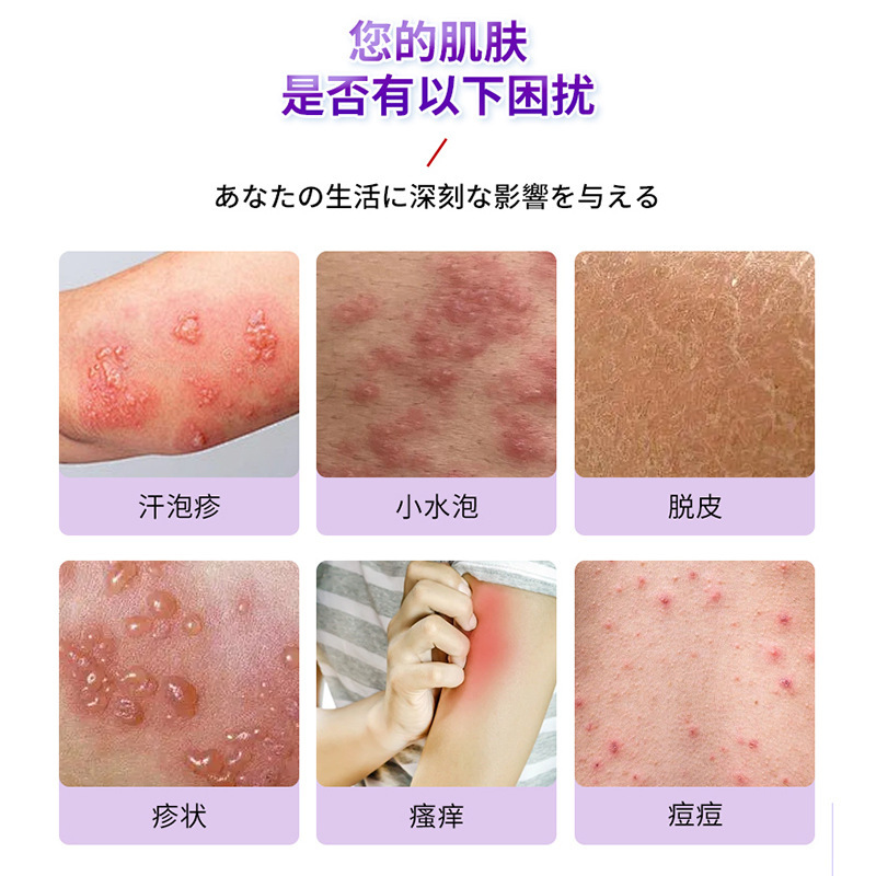 山本星奈汗ヘルペス型保健液は汗の水疱瘡の皮膚の不調を緩和します。|undefined