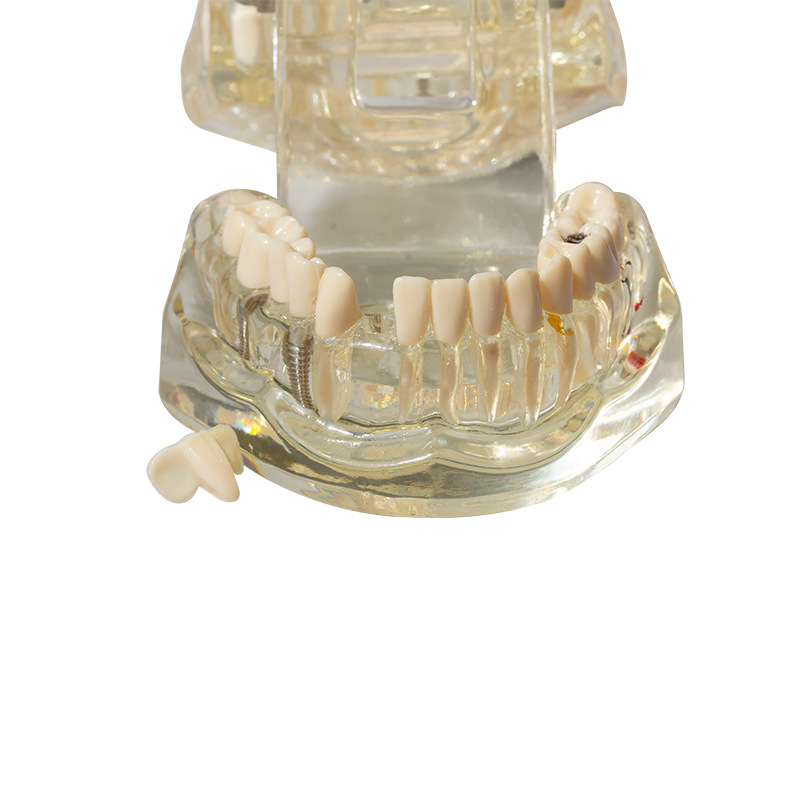 Modelo de implante dental, modelo dental patológico, modelo oral desmontable, modelo de explicación de puente, protección dental