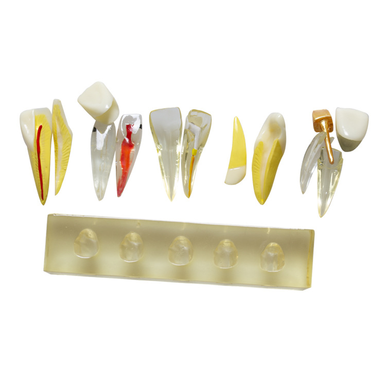 Modelo dental que enseña el modelo oral modelo clínico de la enfermedad de la pulpa del diente anterior modelo patológico