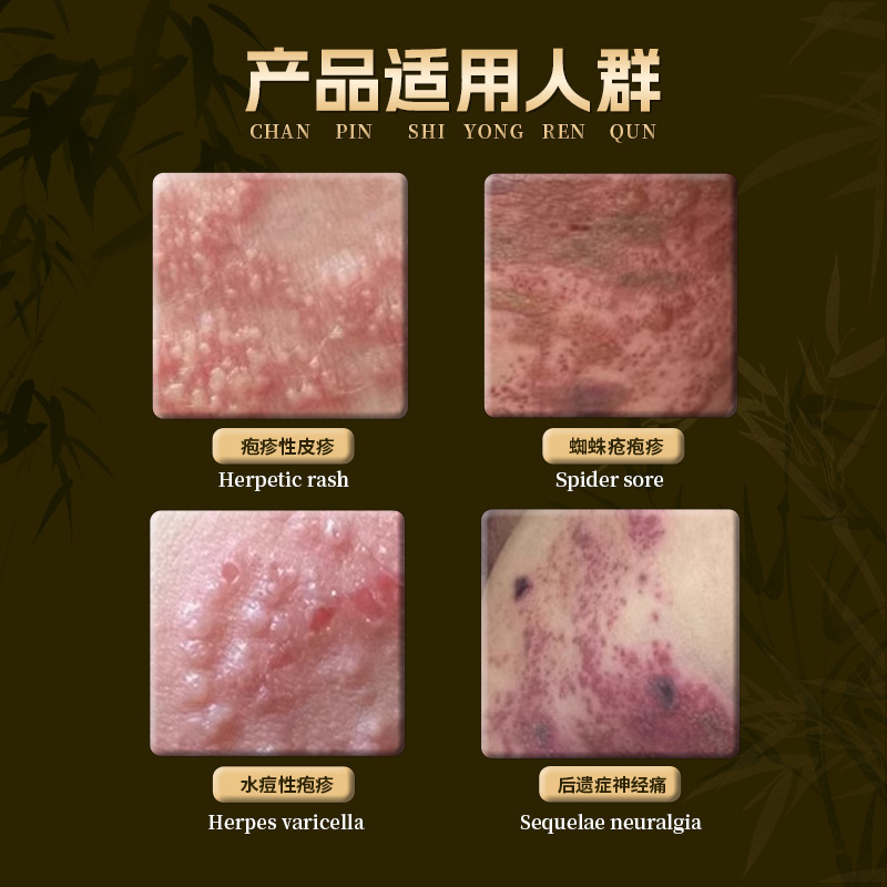 汗疹神経ケアスプレー、皮膚の小さな水疱、手足の皮膚のかゆみスプレー、OEM加工|undefined