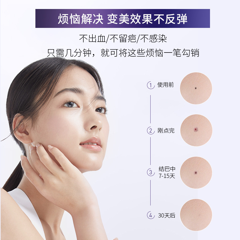 人気の電気プラズマほくろ除去ペン、ほくろ除去ペン、レーザースポットスキャンペン、家庭用美容イオンスポット除去装置|undefined