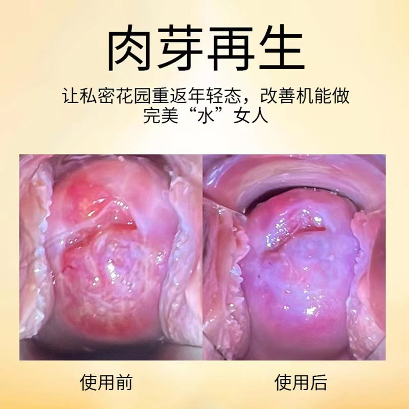 私処小分子肉芽ペプチドゲル私処長肉芽私処は膣コラーゲン肉芽液をしっかりと修復します。|undefined