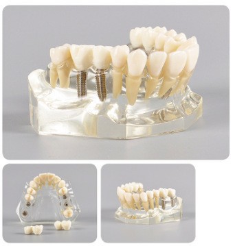Modelo de ortodoncia dental semi-metal semibrackets Práctica de corrección de molde dental estándar Comunicación médico-paciente Modelo de enseñanza Modelo dental