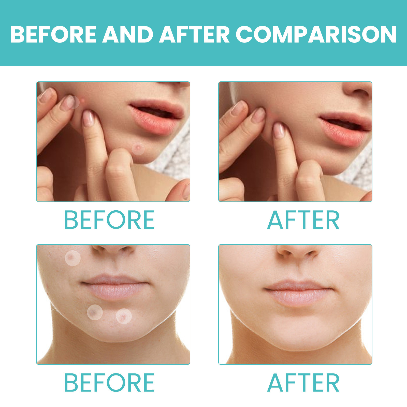 West & Month réparateur d'acné et de pores d'acné, correcteur Invisible et respirant, Patch de nettoyage imperméable pour l'acné_voghion.com