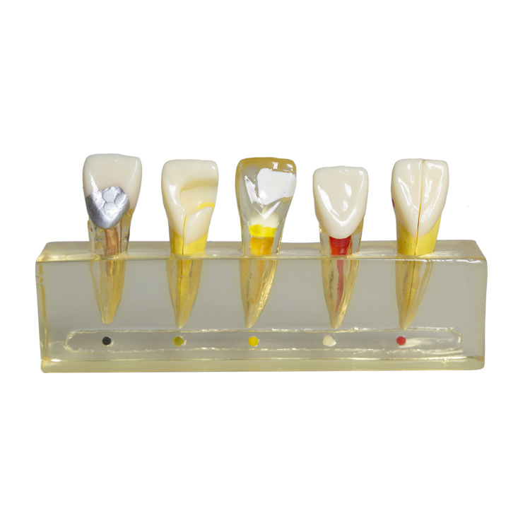 Modelo dental que enseña el modelo oral modelo clínico de la enfermedad de la pulpa del diente anterior modelo patológico