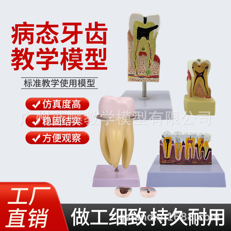 ���ƿ�ǻ�ı�ȣ�ݷֽ�ģ�� ����������ʾȣ�ݷ�չ���� ҽ����ͨ