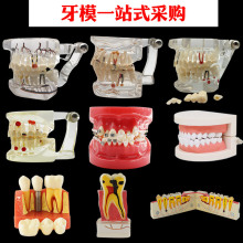 口腔牙模型示例模型可拆卸透明牙模修复体全口病例医患沟通模型