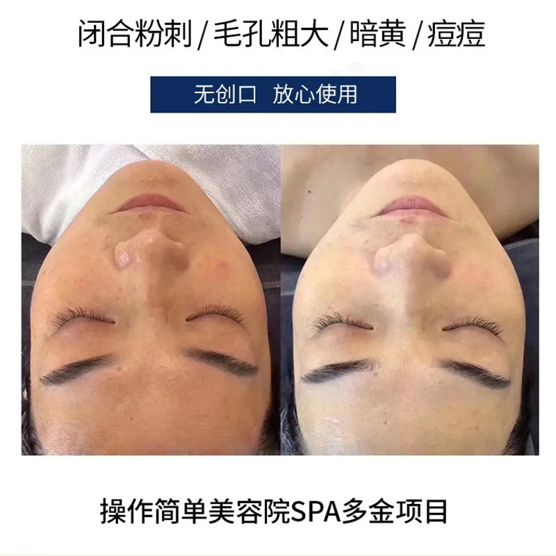 蓝藻海绵微针微晶蓝色骨针美容院焕颜淡化痘印控油收毛孔院线批发|undefined