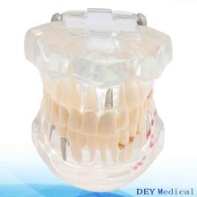 牙模种植修复模型 可拆卸牙齿模型 口腔教学牙模 牙科修复体模型