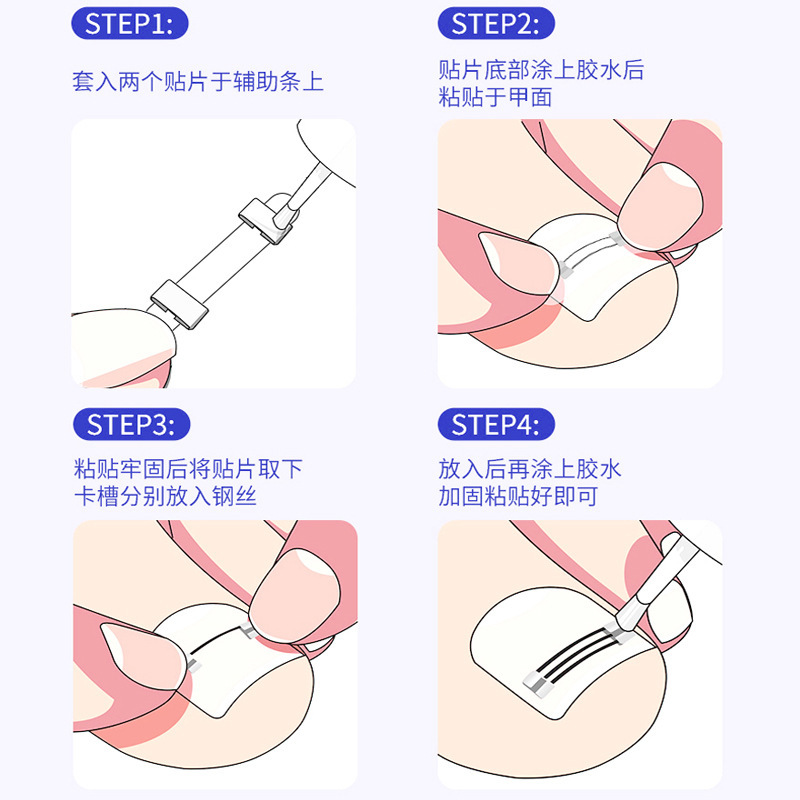 正甲丝镍钛合金记忆正甲贴回弹正甲钢丝指甲扎肉正甲扣嵌甲矫正器|undefined