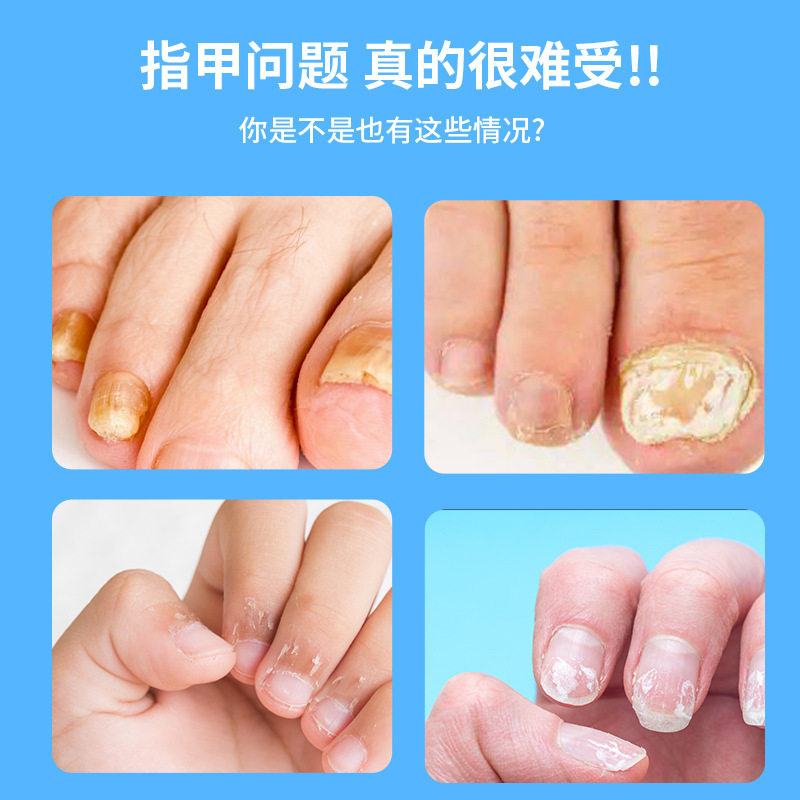 爪真菌症除去クリーム、厚い爪の除去クリーム、爪真菌症除去クリーム、爪軟化フットケアハーブ絆創膏|undefined