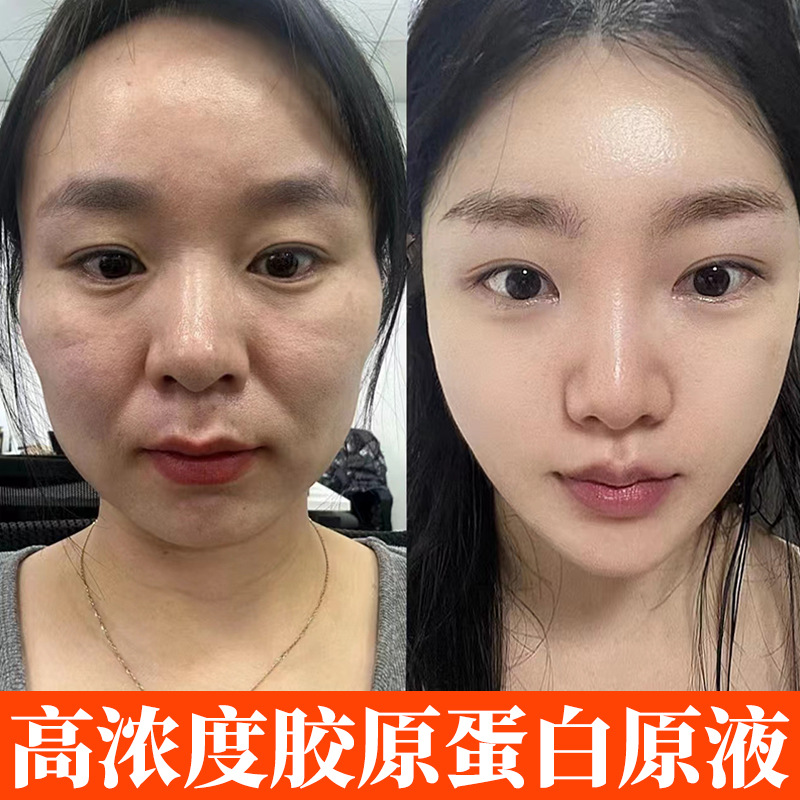 콜라겐 3종 재조합 에센스 주름개선 세럼 탄력 및 리프팅 함몰부위 채움액 보습 및 여드름 흉터 개선